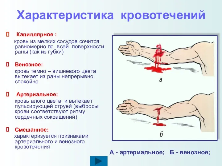 Характеристика кровотечений Капиллярное : кровь из мелких сосудов сочится равномерно по