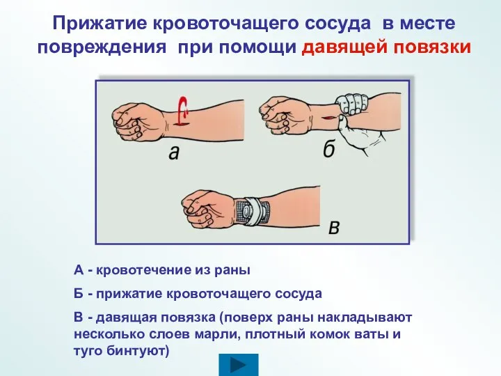 А - кровотечение из раны Б - прижатие кровоточащего сосуда В