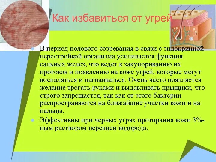 Как избавиться от угрей В период полового созревания в связи с