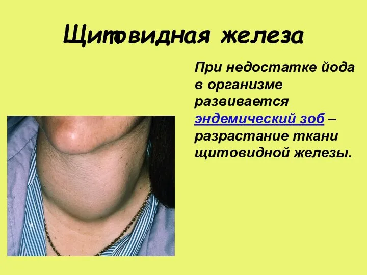 Щитовидная железа При недостатке йода в организме развивается эндемический зоб – разрастание ткани щитовидной железы.