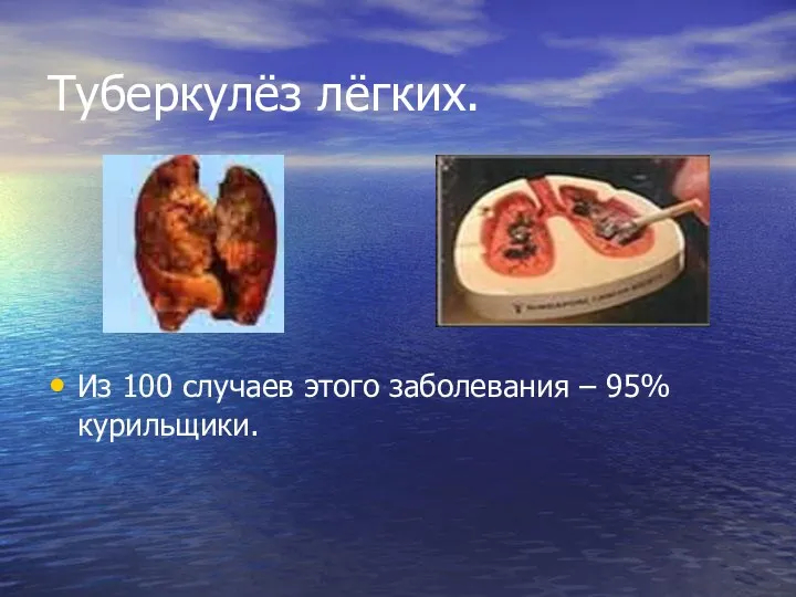 Туберкулёз лёгких. Из 100 случаев этого заболевания – 95% курильщики.