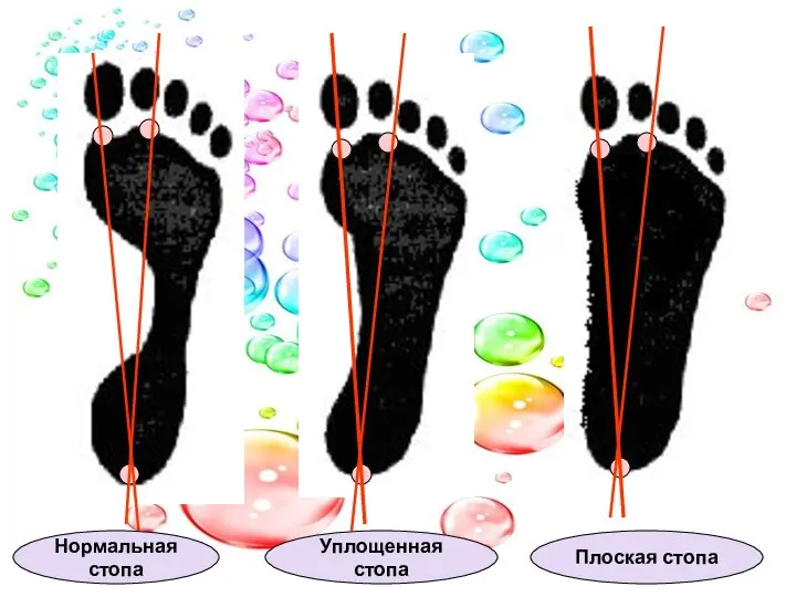 Нормальная стопа Уплощенная стопа Плоская стопа