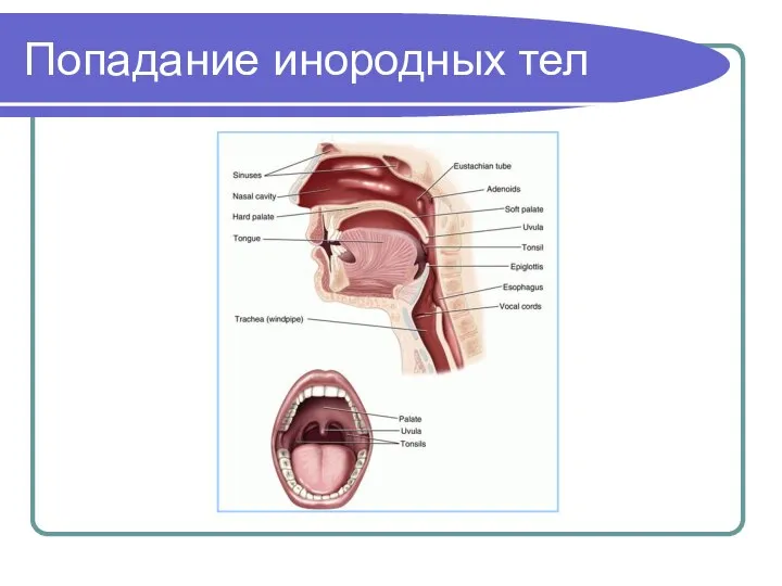 Попадание инородных тел