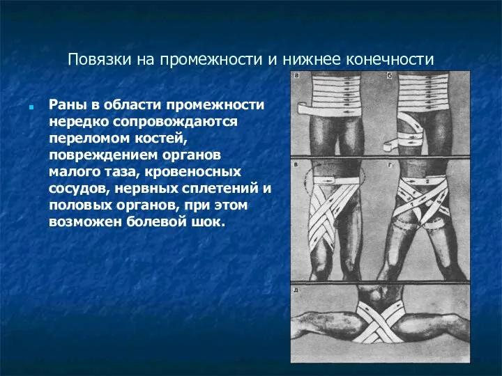 Повязки на промежности и нижнее конечности Раны в области промежности нередко