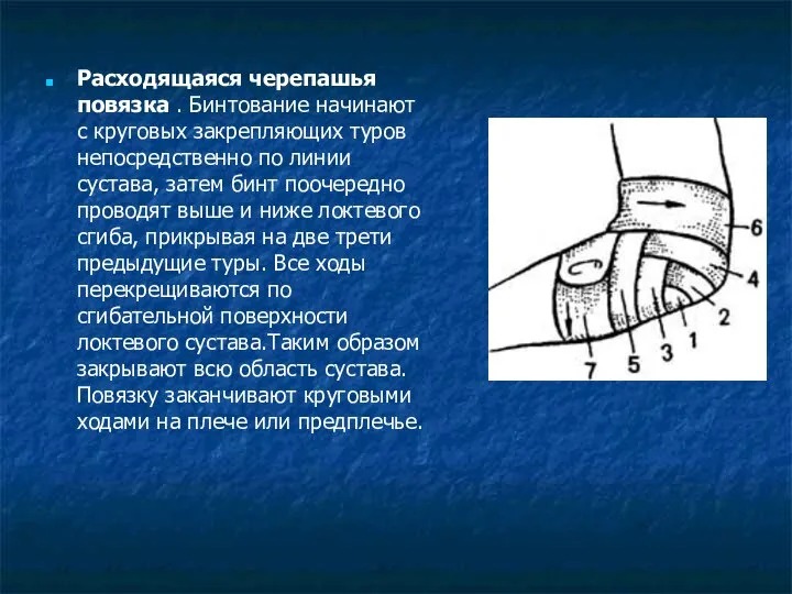 Расходящаяся черепашья повязка . Бинтование начинают с круговых закрепляющих туров непосредственно