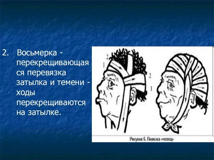 2. Восьмерка - перекрещивающаяся перевязка затылка и темени - ходы перекрещиваются на затылке.