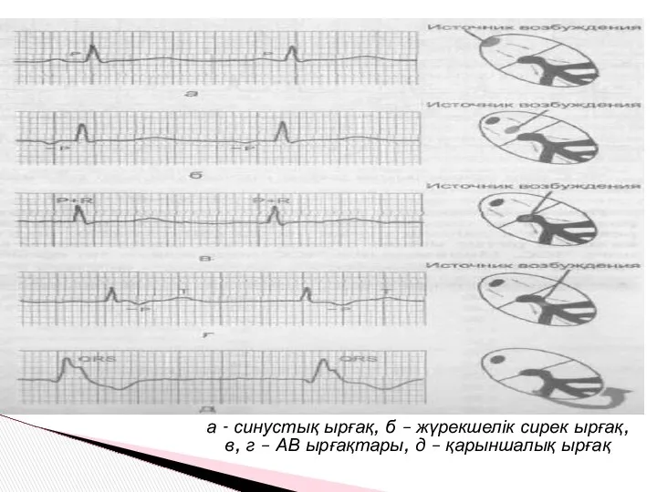 а - синустық ырғақ, б – жүрекшелік сирек ырғақ, в, г