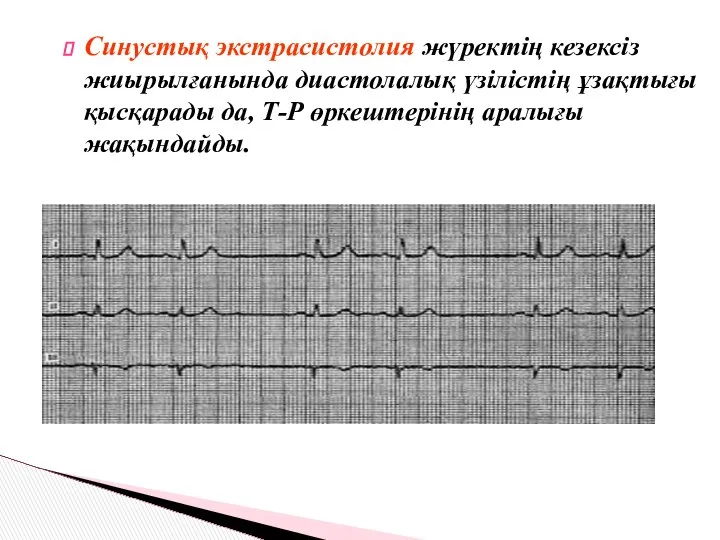 Синустық экстрасистолия жүректің кезексіз жиырылғанында диастолалық үзілістің ұзақтығы қысқарады да, Т-Р өркештерінің аралығы жақындайды.