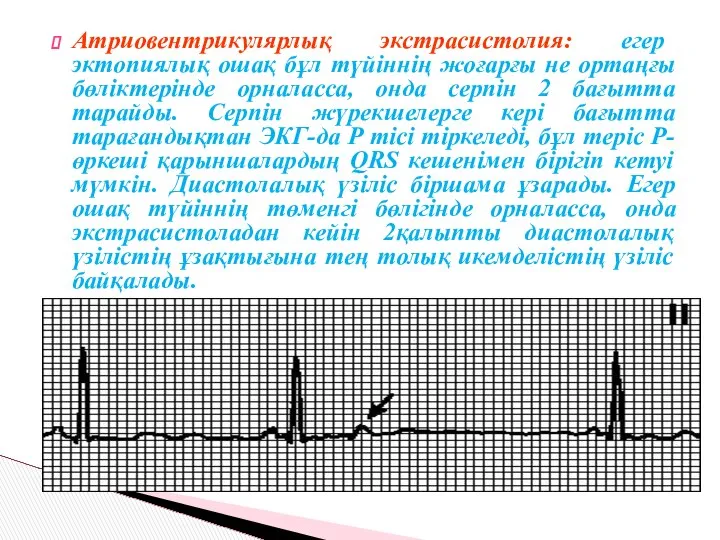 Атриовентрикулярлық экстрасистолия: егер эктопиялық ошақ бұл түйіннің жоғарғы не ортаңғы бөліктерінде