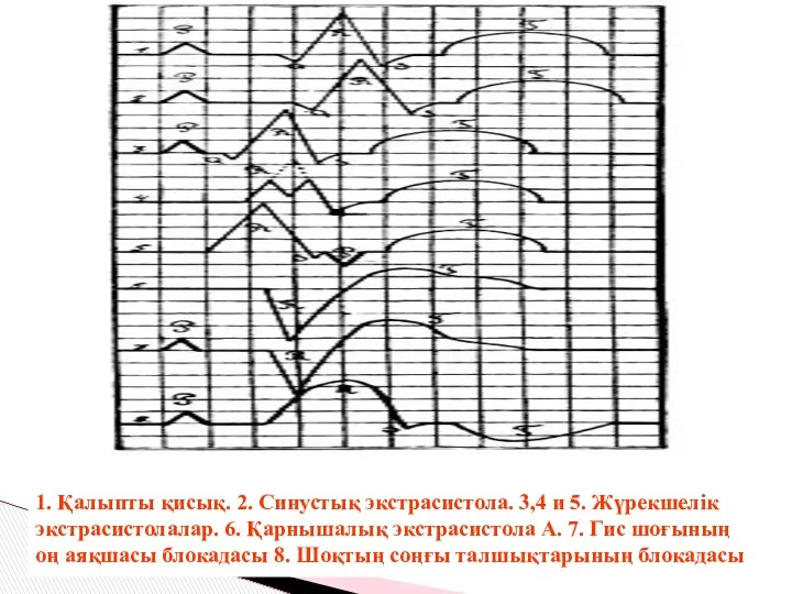 1. Қалыпты қисық. 2. Синустық экстрасистола. 3,4 и 5. Жүрекшелік экстрасистолалар.