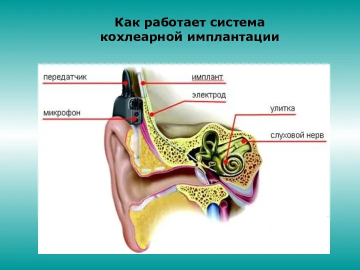 Как работает система кохлеарной имплантации