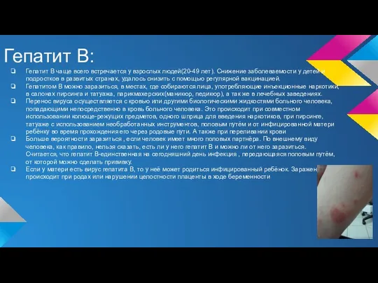 Гепатит В: Гепатит В чаще всего встречается у взрослых людей(20-49 лет).