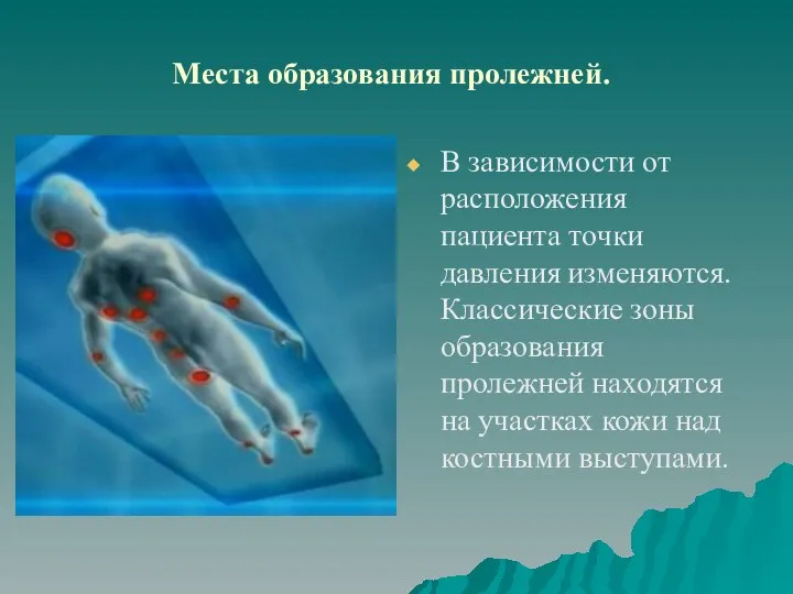 Места образования пролежней. В зависимости от расположения пациента точки давления изменяются.