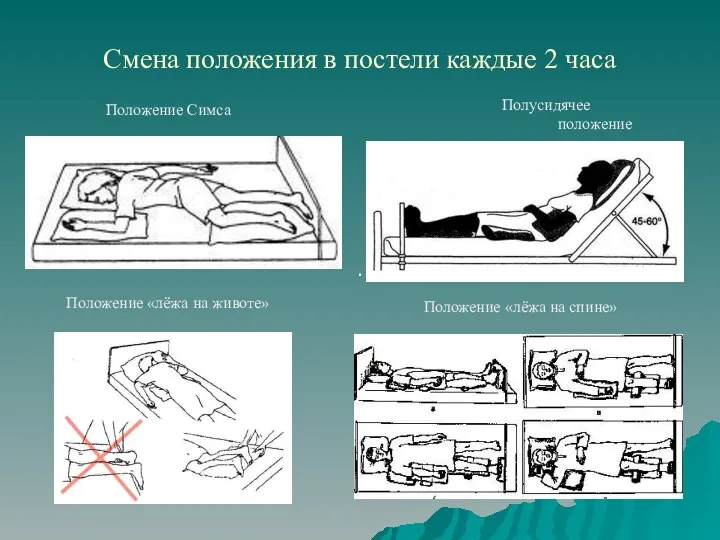 Смена положения в постели каждые 2 часа Положение Симса Положение «лёжа