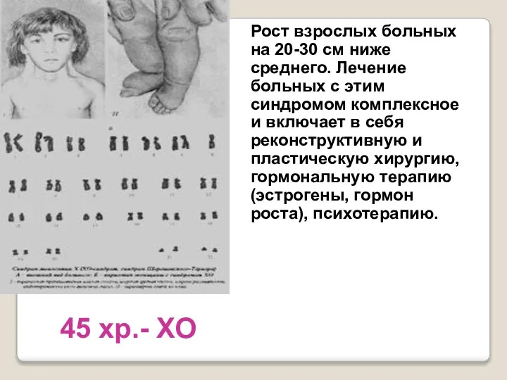 45 хр.- ХО Рост взрослых больных на 20-30 см ниже среднего.