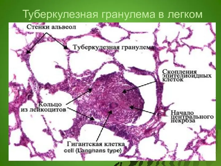 Туберкулезная гранулема в легком