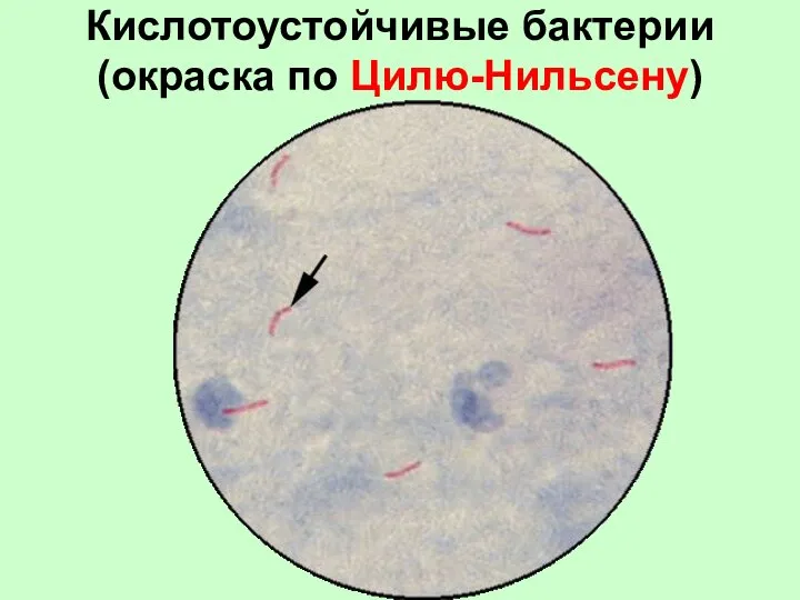 Кислотоустойчивые бактерии (окраска по Цилю-Нильсену)