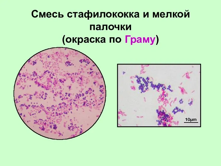 Смесь стафилококка и мелкой палочки (окраска по Граму)