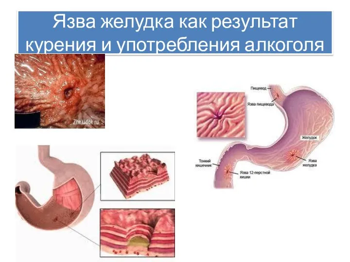 Язва желудка как результат курения и употребления алкоголя