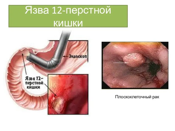 Язва 12-перстной кишки Плоскоклеточный рак