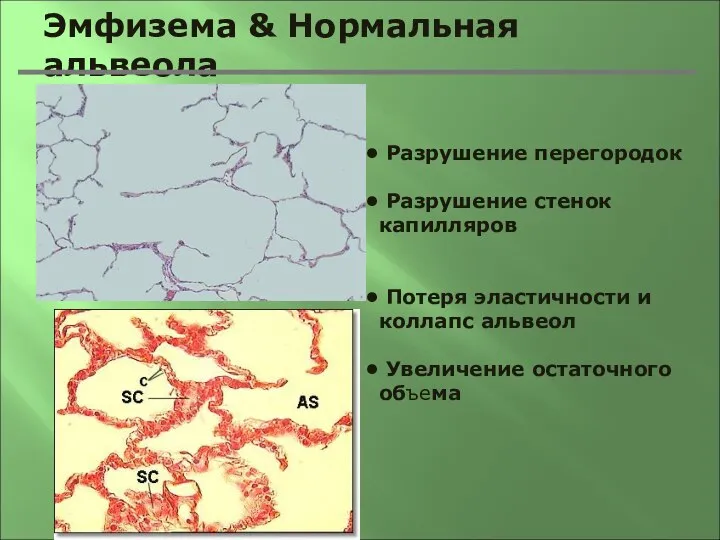 Эмфизема & Нормальная альвеола Разрушение перегородок Разрушение стенок капилляров Потеря эластичности