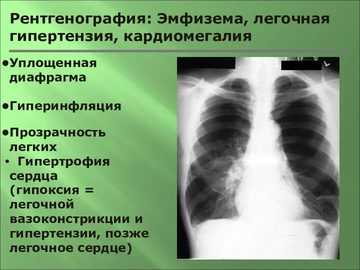 Рентгенография: Эмфизема, легочная гипертензия, кардиомегалия Уплощенная диафрагма Гиперинфляция Прозрачность легких Гипертрофия