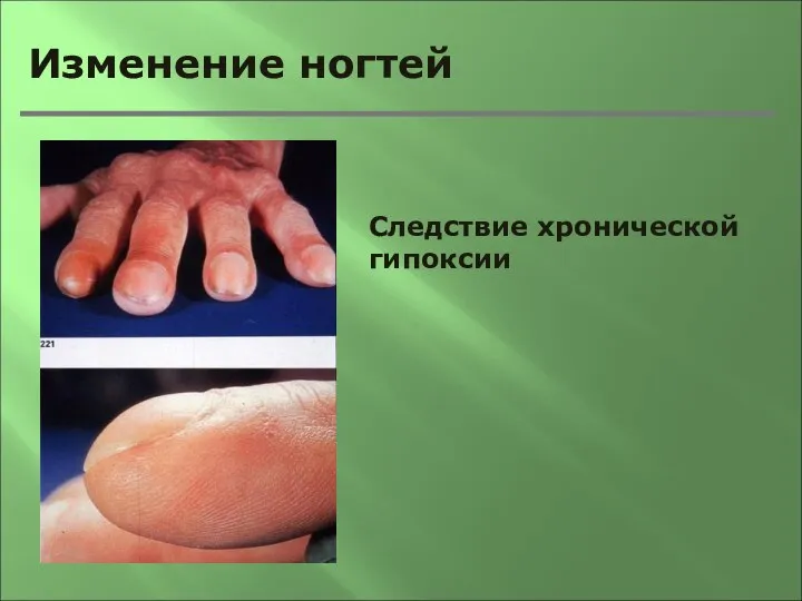 Изменение ногтей Следствие хронической гипоксии