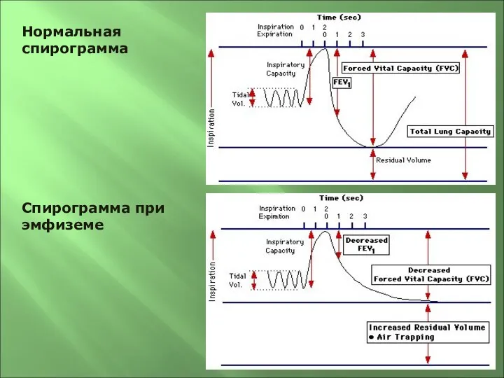 Нормальная спирограмма Спирограмма при эмфиземе
