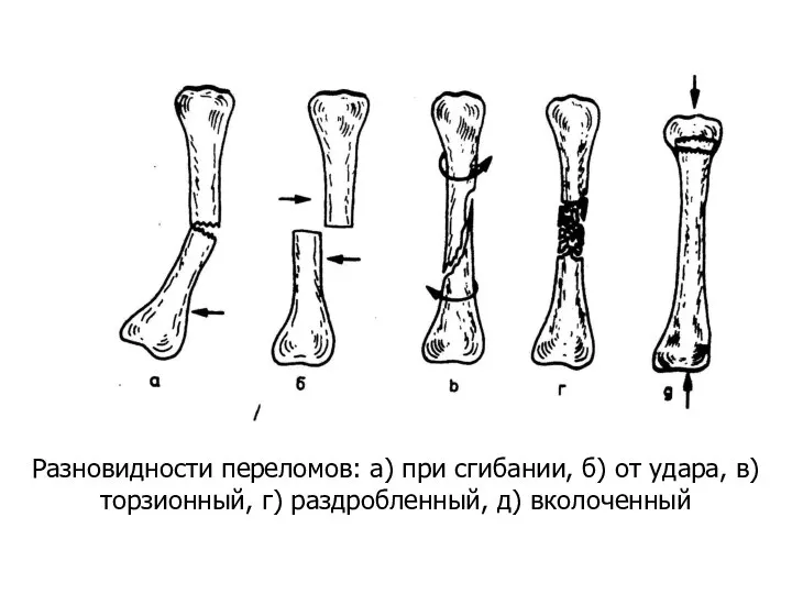 Разновидности переломов: а) при сгибании, б) от удара, в) торзионный, г) раздробленный, д) вколоченный