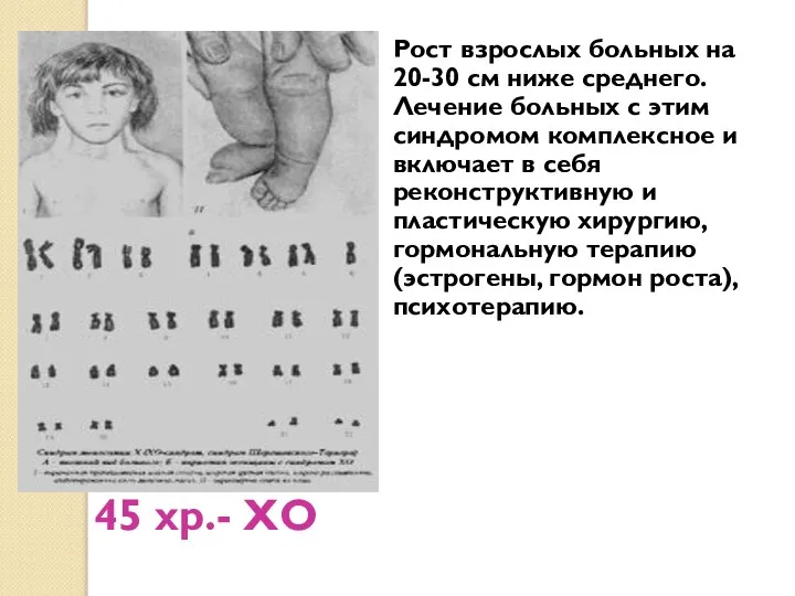 45 хр.- ХО Рост взрослых больных на 20-30 см ниже среднего.