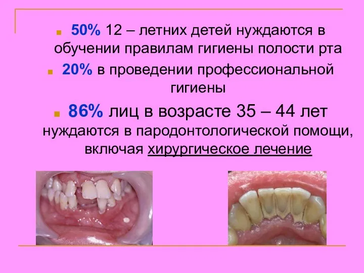 50% 12 – летних детей нуждаются в обучении правилам гигиены полости