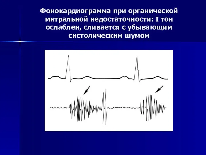 Фонокардиограмма при органической митральной недостаточности: I тон ослаблен, сливается с убывающим систолическим шумом