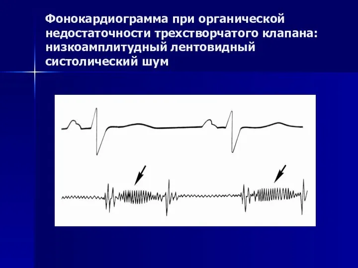 Фонокардиограмма при органической недостаточности трехстворчатого клапана: низкоамплитудный лентовидный систолический шум