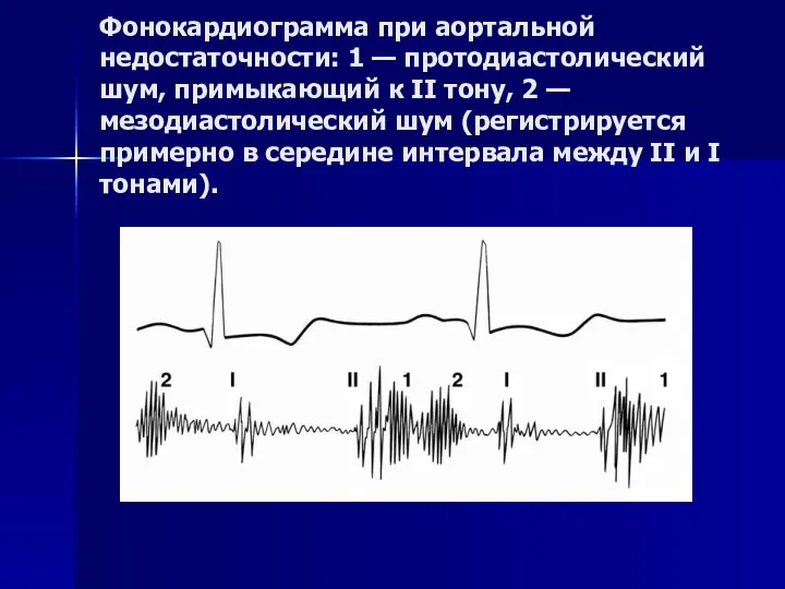 Фонокардиограмма при аортальной недостаточности: 1 — протодиастолический шум, примыкающий к II