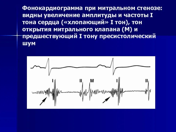 Фонокардиограмма при митральном стенозе: видны увеличение амплитуды и частоты I тона