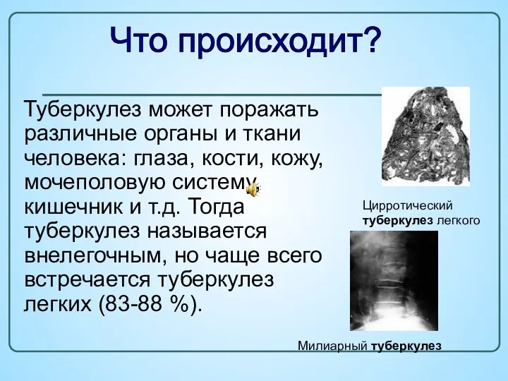 Туберкулез может поражать различные органы и ткани человека: глаза, кости, кожу,