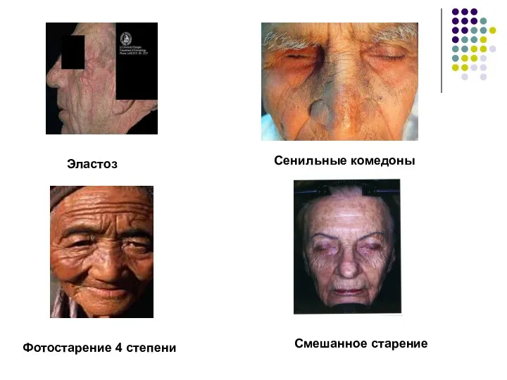 Эластоз Сенильные комедоны Фотостарение 4 степени Смешанное старение