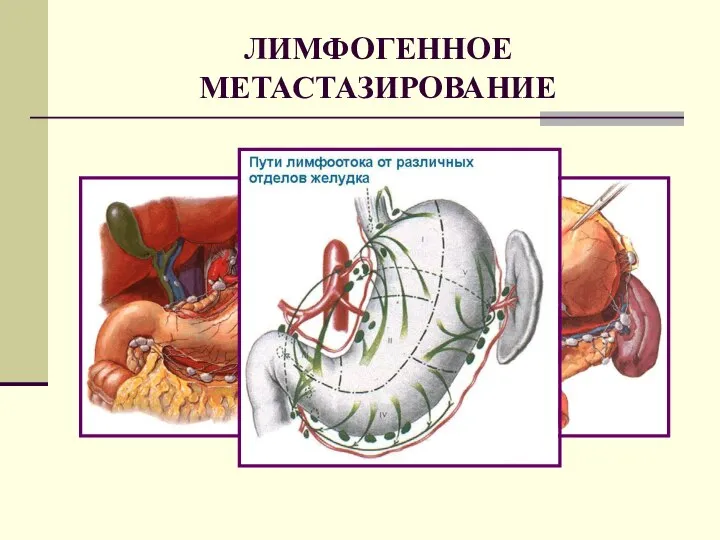 ЛИМФОГЕННОЕ МЕТАСТАЗИРОВАНИЕ РАСПРОСТРАНЕНИЕ ПО ЛИМФАТИЧЕСКОЙ СИСТЕМЕ