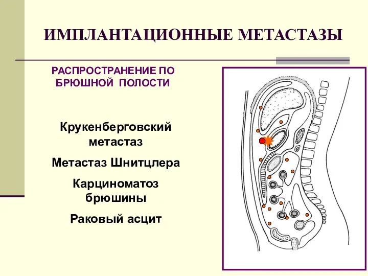 ИМПЛАНТАЦИОННЫЕ МЕТАСТАЗЫ РАСПРОСТРАНЕНИЕ ПО БРЮШНОЙ ПОЛОСТИ Крукенберговский метастаз Метастаз Шнитцлера Карциноматоз брюшины Раковый асцит