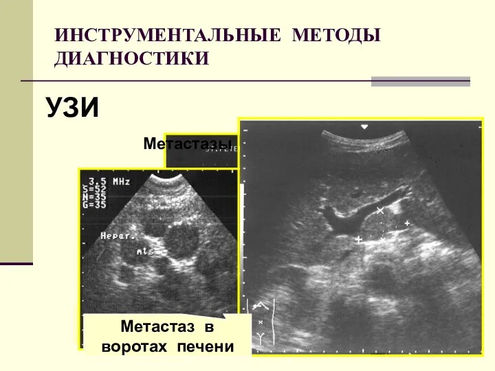 ИНСТРУМЕНТАЛЬНЫЕ МЕТОДЫ ДИАГНОСТИКИ УЛЬТРАЗВУКОВОЕ СКАНИРОВАНИЕ ПЕРВИЧНАЯ ОПУХОЛЬ (эндофитный рост) Метастазы в