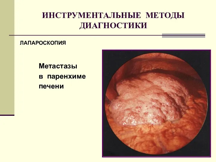 ИНСТРУМЕНТАЛЬНЫЕ МЕТОДЫ ДИАГНОСТИКИ ЛАПАРОСКОПИЯ Метастазы в паренхиме печени ЛАПАРОСКОПИЯ