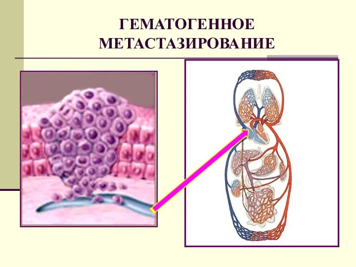 ГЕМАТОГЕННОЕ МЕТАСТАЗИРОВАНИЕ