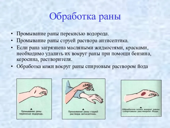 Обработка раны Промывание раны перекисью водорода. Промывание раны струей раствора антисептика.