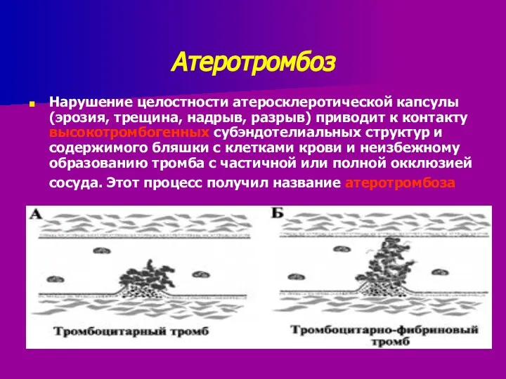 Атеротромбоз Нарушение целостности атеросклеротической капсулы (эрозия, трещина, надрыв, разрыв) приводит к