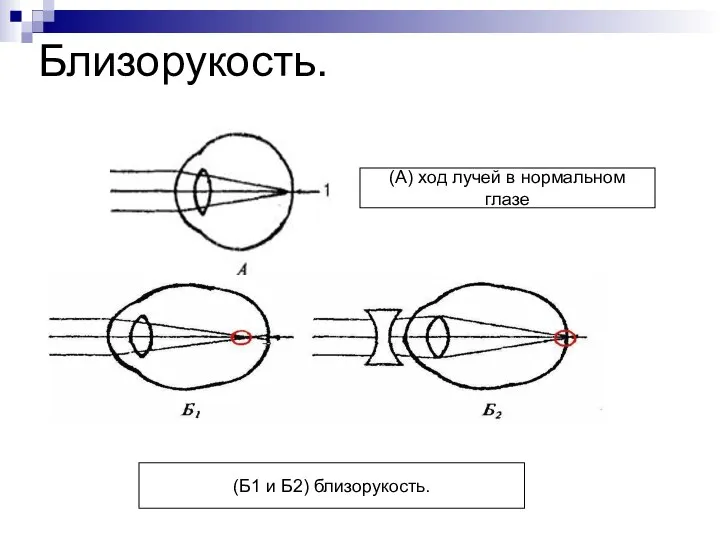 Близорукость. (А) ход лучей в нормальном глазе (Б1 и Б2) близорукость.