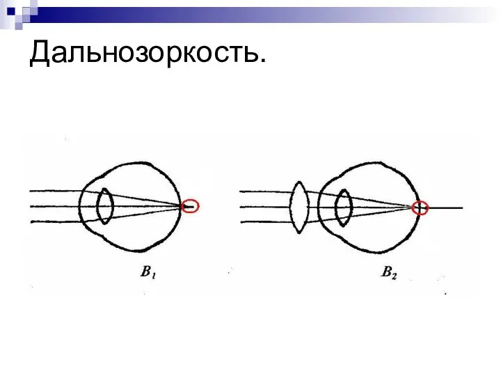 Дальнозоркость.