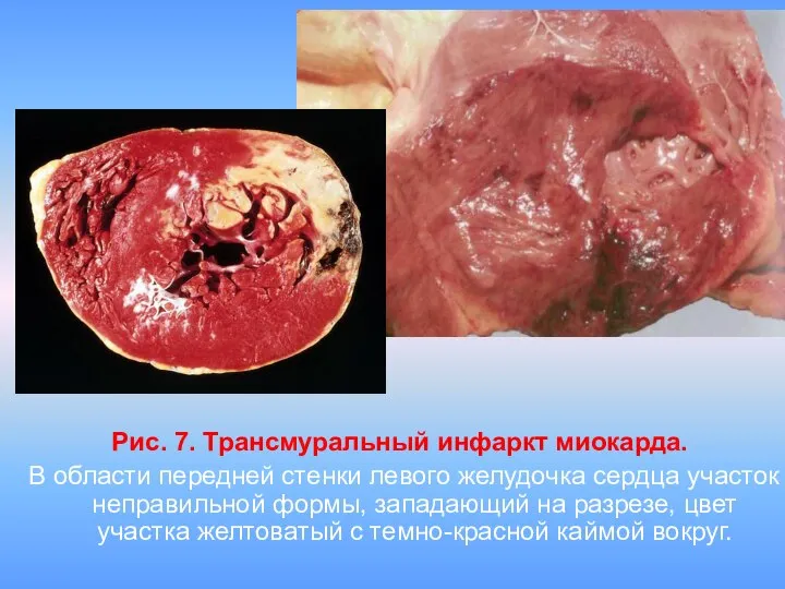 Рис. 7. Трансмуральный инфаркт миокарда. В области передней стенки левого желудочка