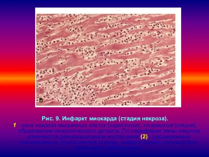 Рис. 9. Инфаркт миокарда (стадия некроза). 1 - зона некроза мышечных