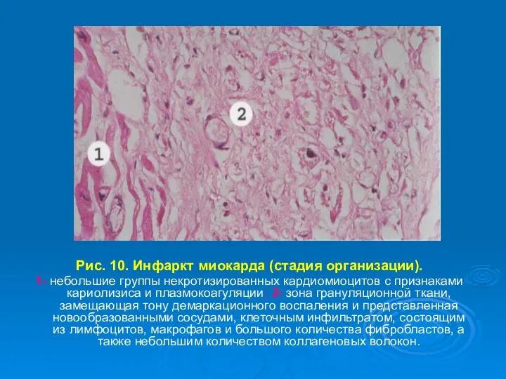 Рис. 10. Инфаркт миокарда (стадия организации). 1- небольшие группы некротизированных кардиомиоцитов