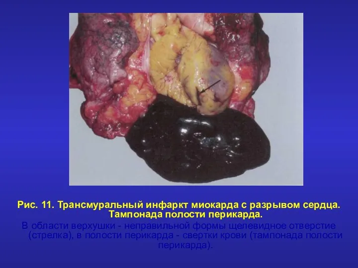 Рис. 11. Трансмуральный инфаркт миокарда с разрывом сердца. Тампонада полости перикарда.